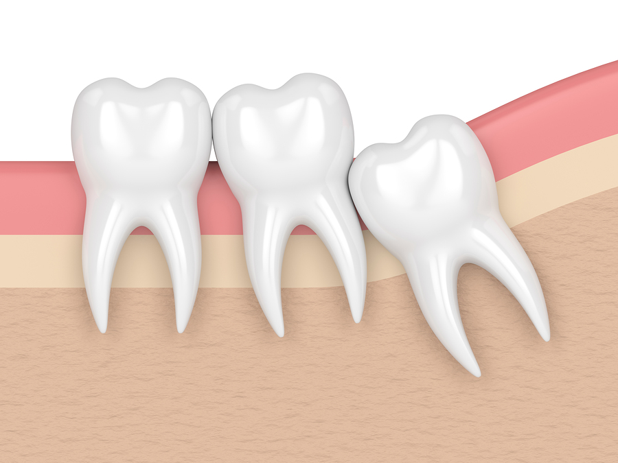 3d render of teeth with wisdom crowding. Concept of different types of wisdom teeth problems.